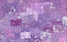 Argonne researching are using Singularity as part of their work with the CANDLE project, which aims to predict cancer type and drug response using histopathology images from the National Cancer Institute’s Patient-Derived Models Repository. (Image credit: Rick Stevens, Argonne National Laboratory)